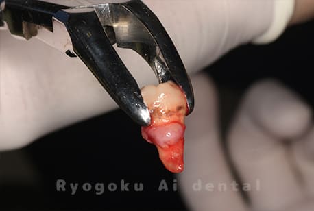 自家歯牙移植の親知らず