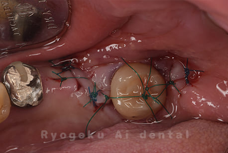 自家歯牙移植術後