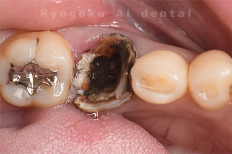 右下6番 重度カリエス