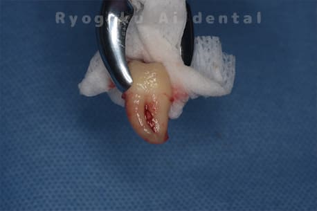 自家歯牙移植の親知らず