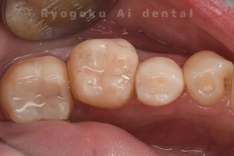 自家歯牙移植術後補綴装着