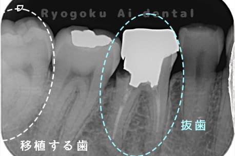右下6番 重度カリエスレントゲン