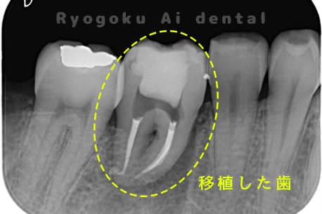 右下8を右下6へ移植に自家歯牙移植後のレントゲン