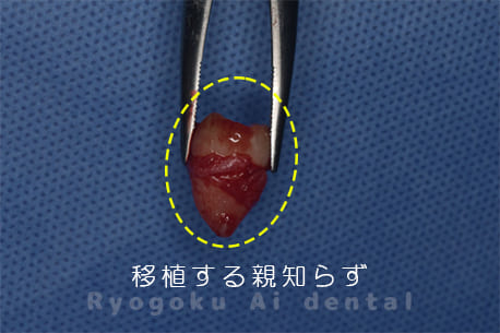 自家歯牙移植の親知らず
