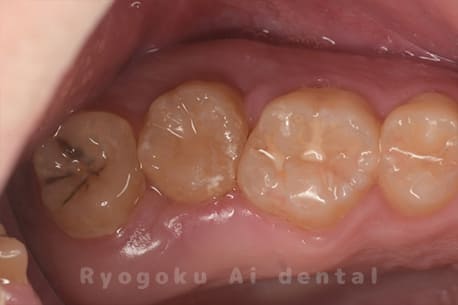 自家歯牙移植術後