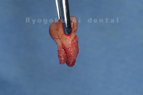 自家歯牙移植の親知らず