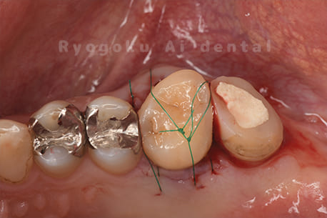 自家歯牙移植術中