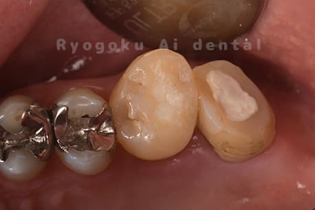 自家歯牙移植術後