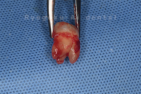 自家歯牙移植術後