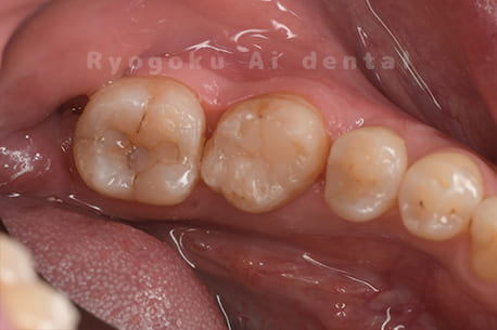 自家歯牙移植術後補綴装着