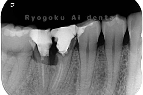 右下6番 重度カリエスレントゲン