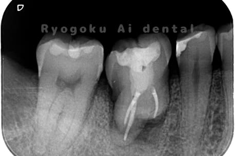 右下8を右下6へ移植に自家歯牙移植後のレントゲン