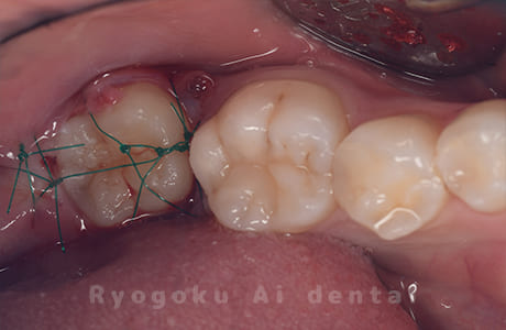 自家歯牙移植術後