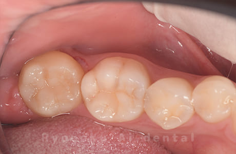 自家歯牙移植術治療完了
