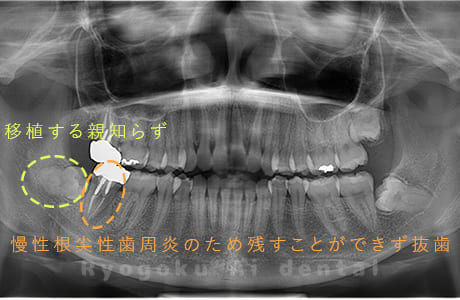 右下７番慢性根尖性歯周炎、右下８番智歯周囲炎