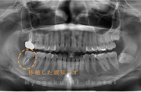 自家歯牙移植後のレントゲン