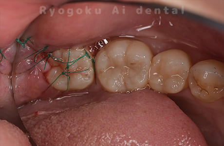 自家歯牙移植術後