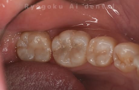 自家歯牙移植術治療完了