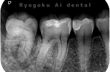 自家歯牙移植後