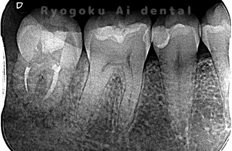自家歯牙移植術完了
