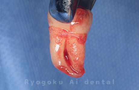 自家歯牙移植の親知らず