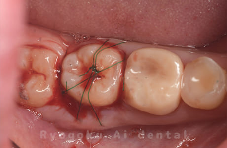 自家歯牙移植術後