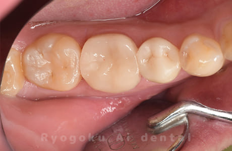 自家歯牙移植術治療完了