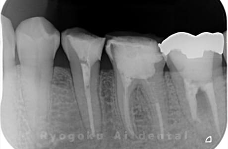 左下７番破折レントゲン