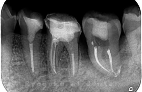 自家歯牙移植後のレントゲン