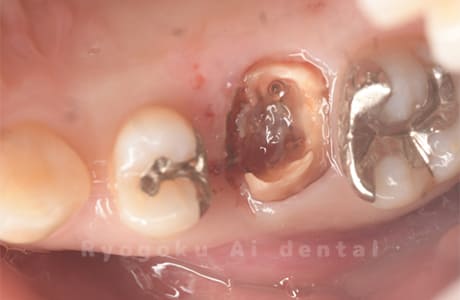 重度カリエス、歯牙破折