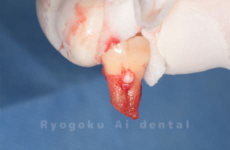 自家歯牙移植の親知らず