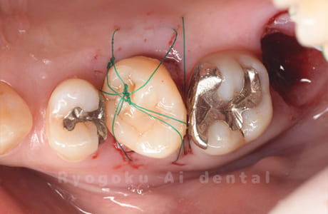 自家歯牙移植術後