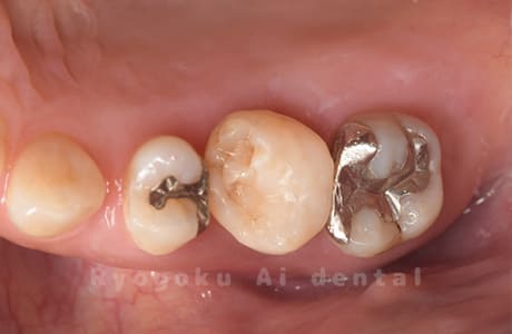 自家歯牙移植術治療完了