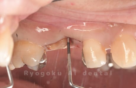 重度カリエス、歯牙破折のレントゲン