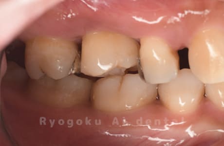 自家歯牙移植後のレントゲン