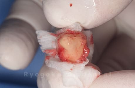 自家歯牙移植の親知らず