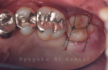 自家歯牙移植術後