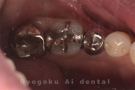 重度カリエス、インレー・クラウン二次カリエス
