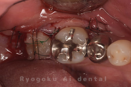 自家歯牙移植の親知らず