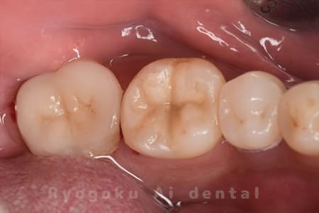 自家歯牙移植術後