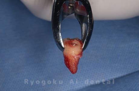 自家歯牙移植の親知らず