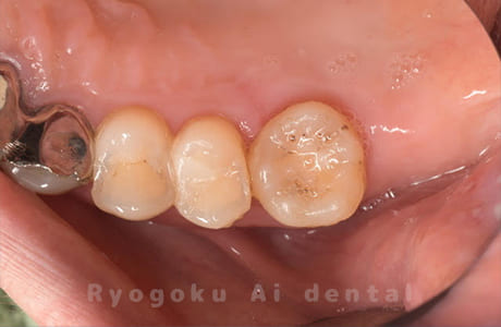 自家歯牙移植術後