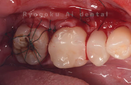 親知らずを自家歯牙移植