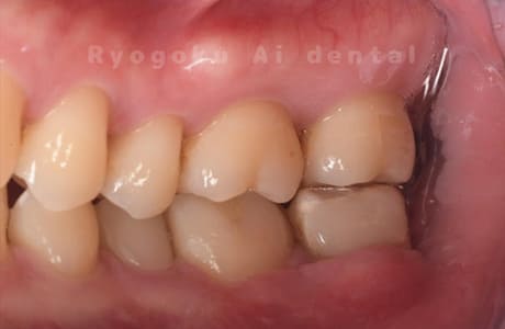 自家歯牙移植術後