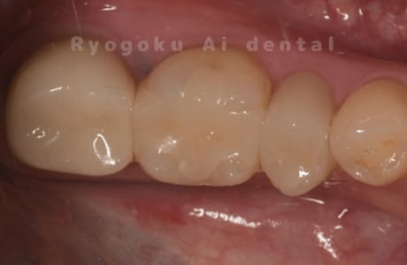 自家歯牙移植術治療完了