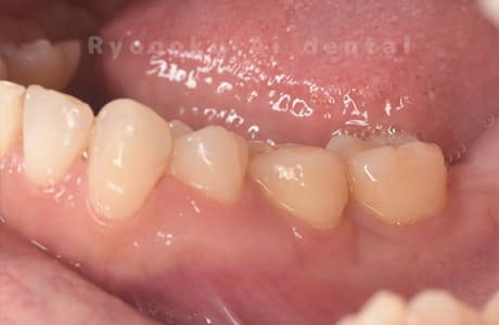 自家歯牙移植術治療完了