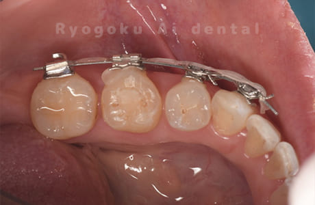 部分矯正術前装置装着
