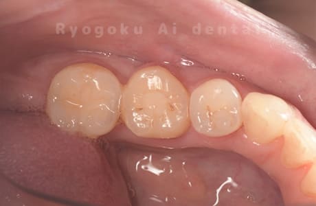 部分矯正治療完了