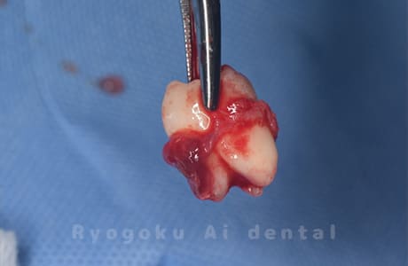 自家歯牙移植の親知らず