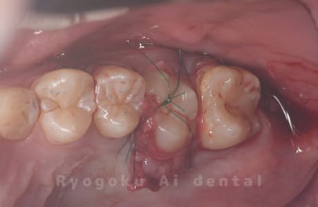 自家歯牙移植術後